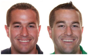 Invisalign-Before-After-01