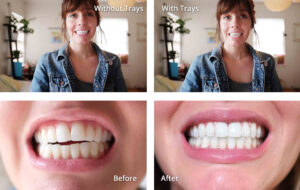 Invisalign-Before-After-02
