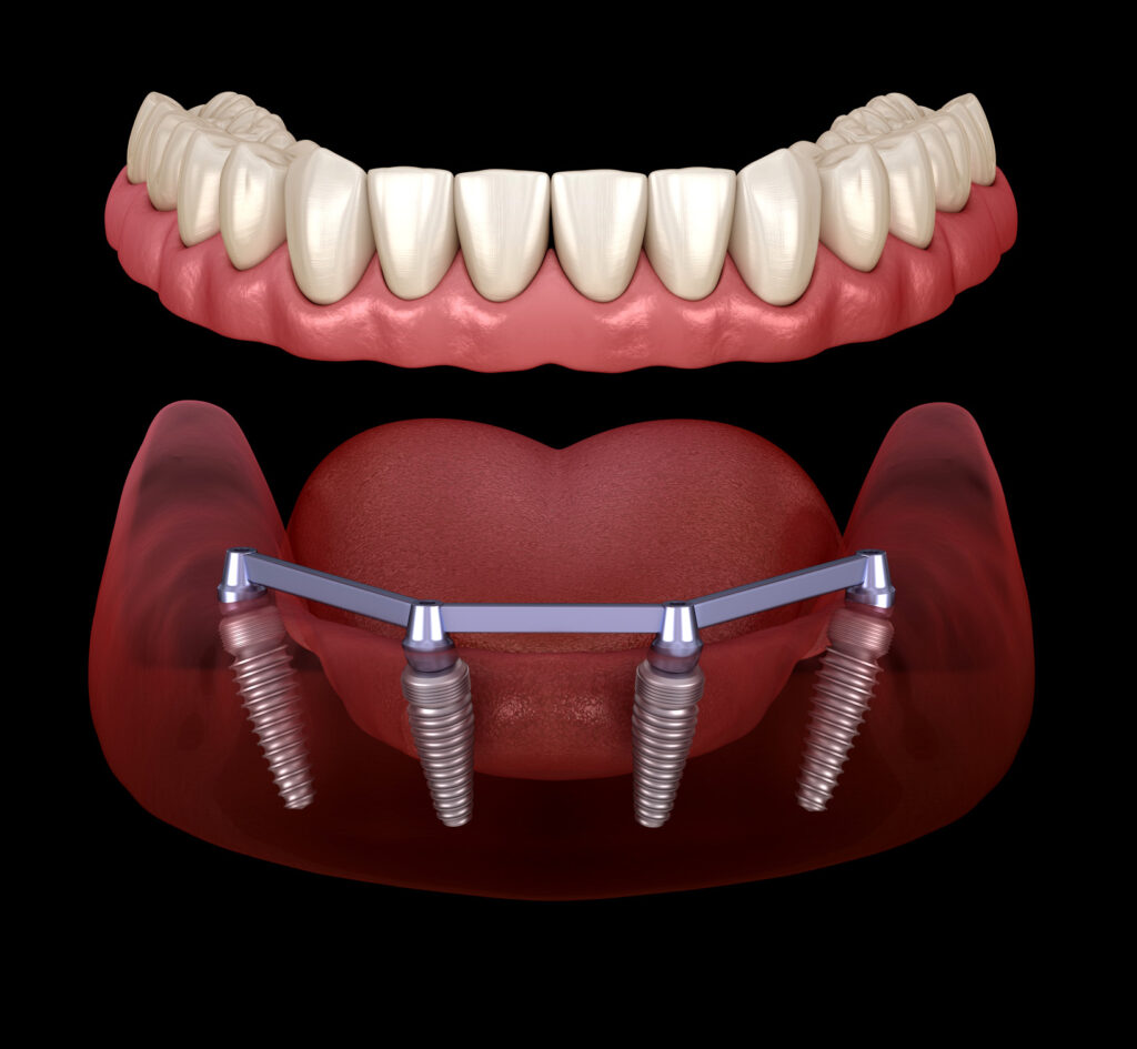 Mandibular prosthesis with gum All on 4 system supported by implants. Medically accurate 3D illustration of human teeth and dentures concept
