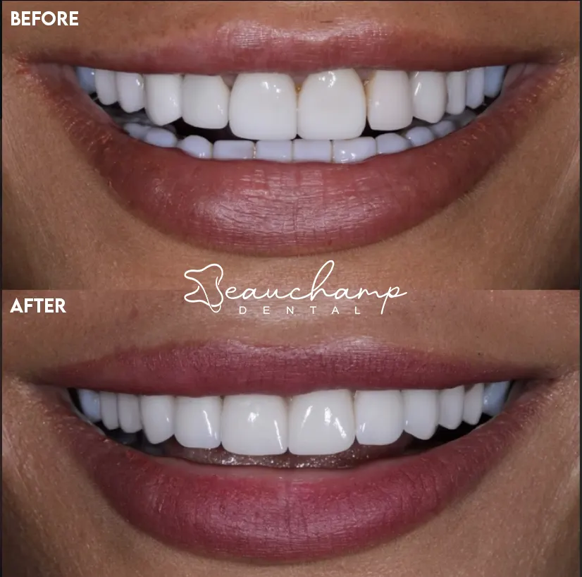 Before and after a smile transformation at Beauchamp Dental