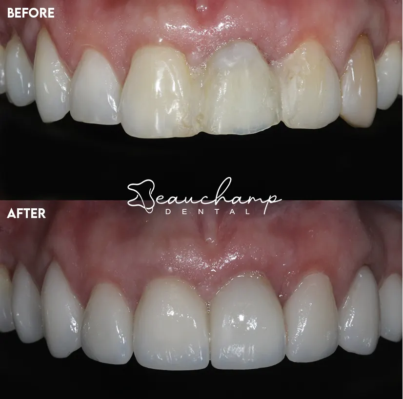 Cosmetic dentistry smile result