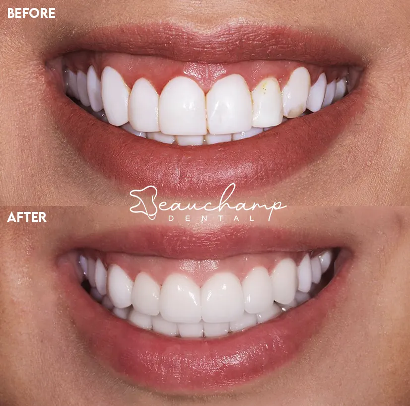 Smile makeover detail