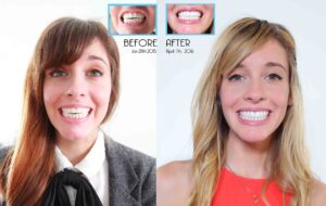 Invisalign-Before-After-03