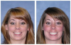 Invisalign-Before-After-07