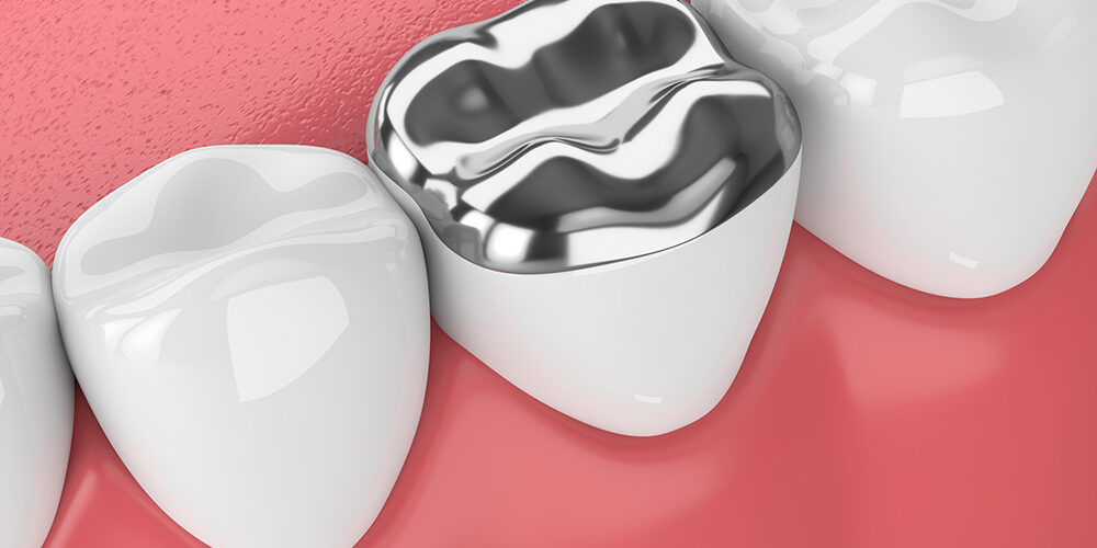 Change-Those-Old-Fillings