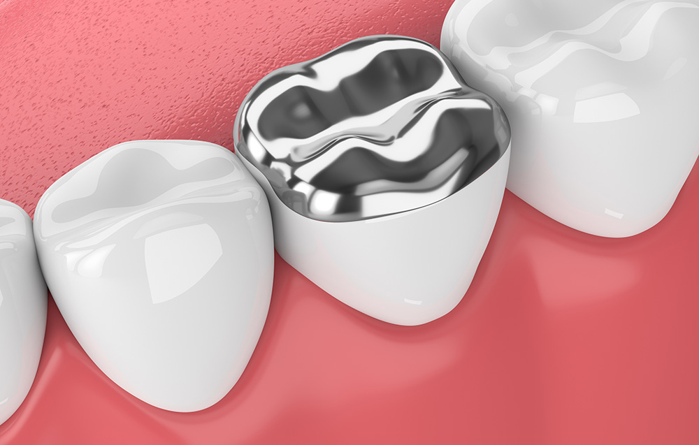 Change-Those-Old-Fillings