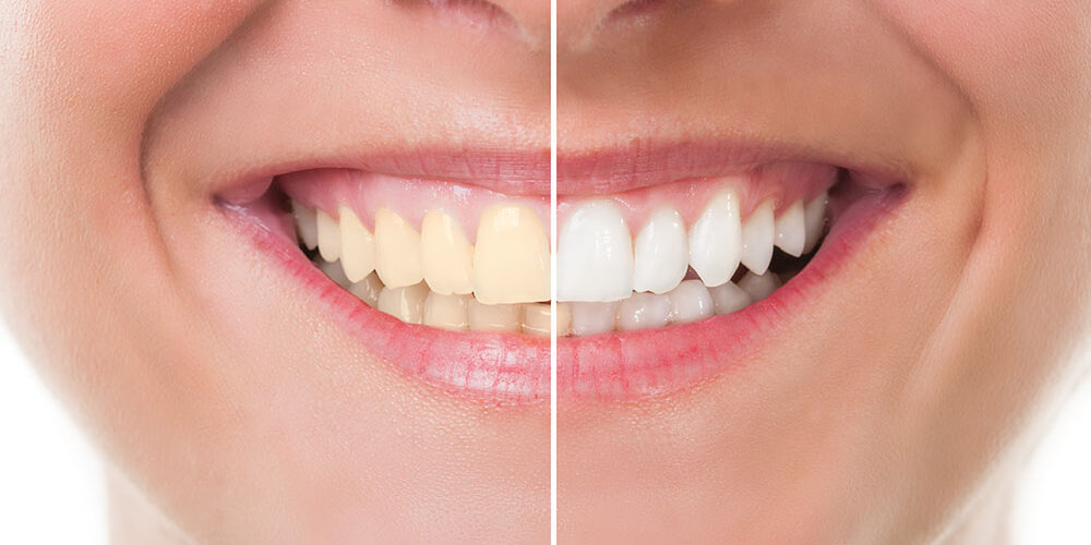 Want Whiter Teeth? Want Whiter Teeth?