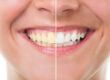 Want Whiter Teeth?