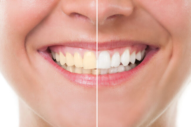 Want Whiter Teeth?