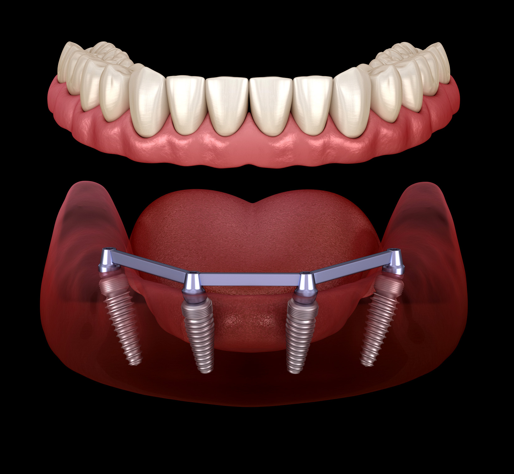 Dental Implants Beauchamp Dental